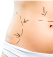 LIPOSUCTION